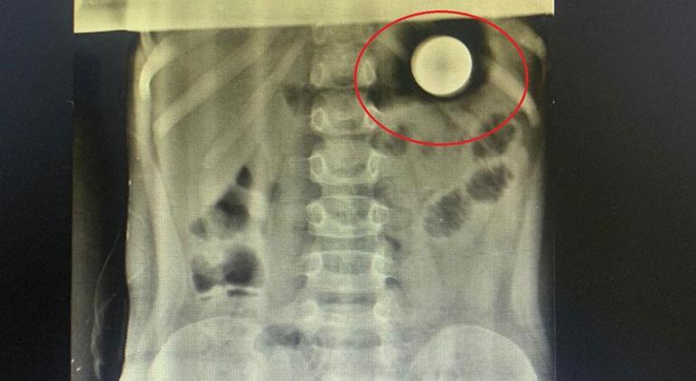 5 yaşındaki Irmak, yuttuğu madeni paradan 14 gün sonra kurtuldu
