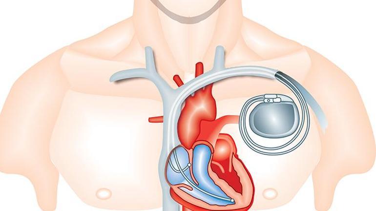 Kalıcı kalp pili takılanların adım adım uyması gereken 8 hayati kural