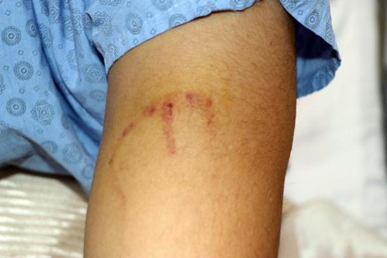 20 kişinin saldırdığı doktor isyan etti Demir sopayla vurup, kolumu ısırdılar