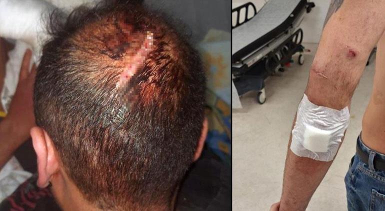 Sevgililere gece kulübü çalışanlarından çivili sopalı saldırı Genç kadının kafasında şişe patlattılar