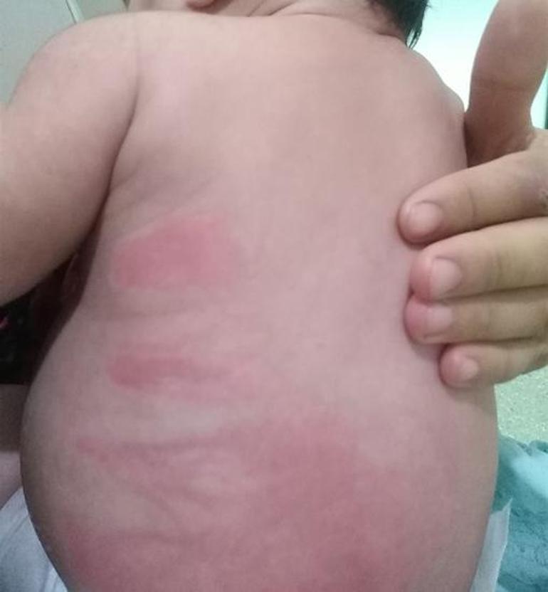 Hastanede yatan bebekte yanık izleri ‘Doktor raporu’ isyan ettirdi