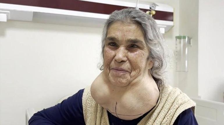 50 yıl boyunca hastaneye gitmedi, 2 kiloluk kitleyle bir ömür yaşadı