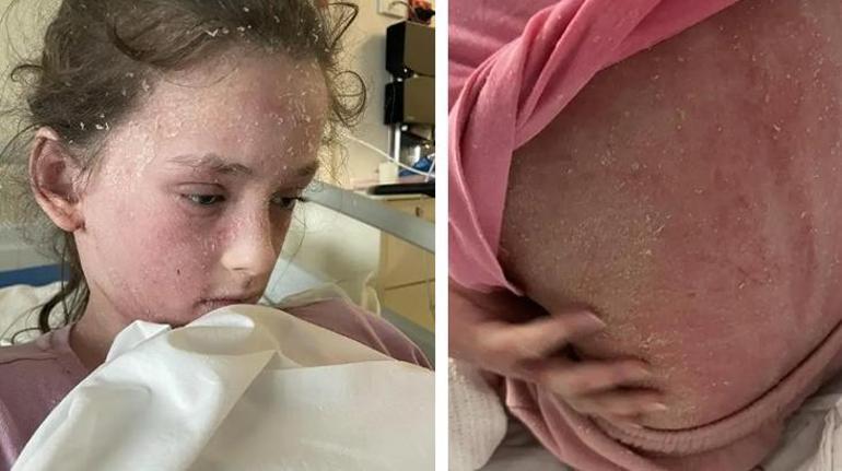 Ateşler içinde yandı, derisi pul pul döküldü Kendine alerjisi varmış, Türkiyede artıyor