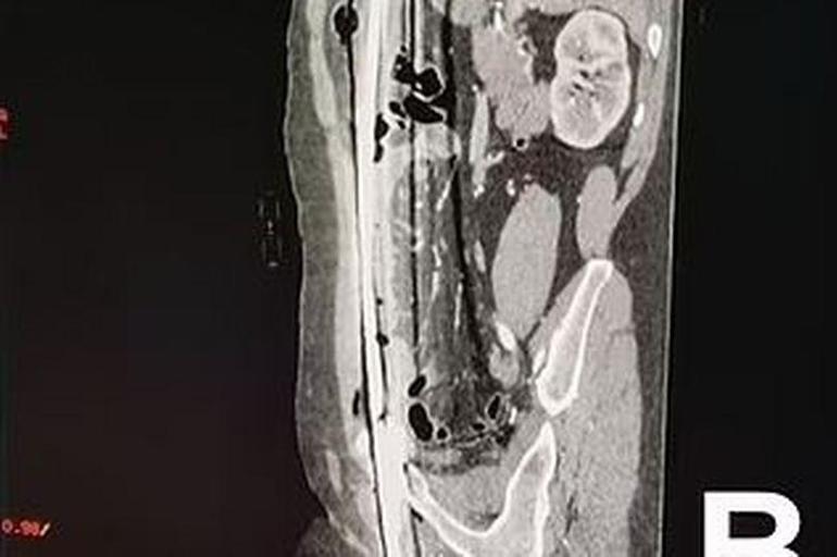Demir parçası kasığından göğsüne kadar saplandı Mucize eseri hayatta kaldı: Kan donduran röntgenler