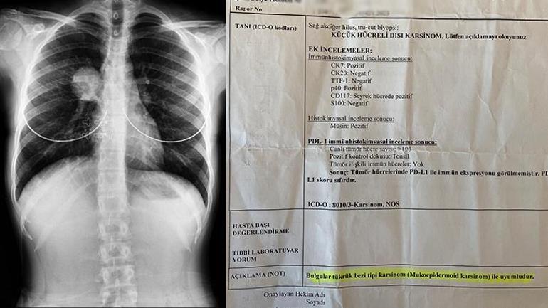 Sayısız doktor dolaştı, D vitamini hatası öldürecekti En büyük şansı tümörü oldu