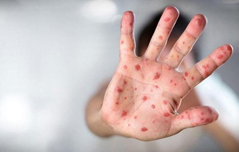 Sağlık Bakanlığından Maymun Çiçeği  (MPOX) rehberi: Nasıl bulaşıyor, belirtileri neler