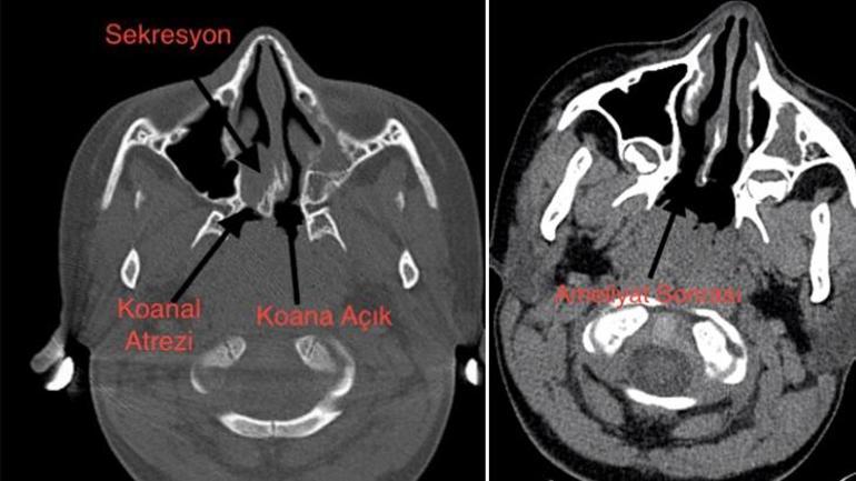 Bitmeyen burun akıntısının sebebi koanal atrezi olabilir 8 bin doğumda bir görülüyor