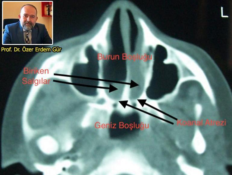 Bitmeyen burun akıntısının sebebi koanal atrezi olabilir 8 bin doğumda bir görülüyor