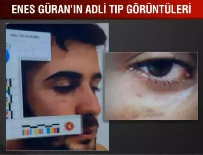 Narin Güran cinayetinin sırrı bu izlerde mi gizli İşte ağabey Enesin kolundaki ısırık izi