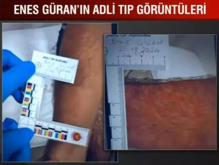 Narin Güran cinayetinin sırrı bu izlerde mi gizli İşte ağabey Enesin kolundaki ısırık izi