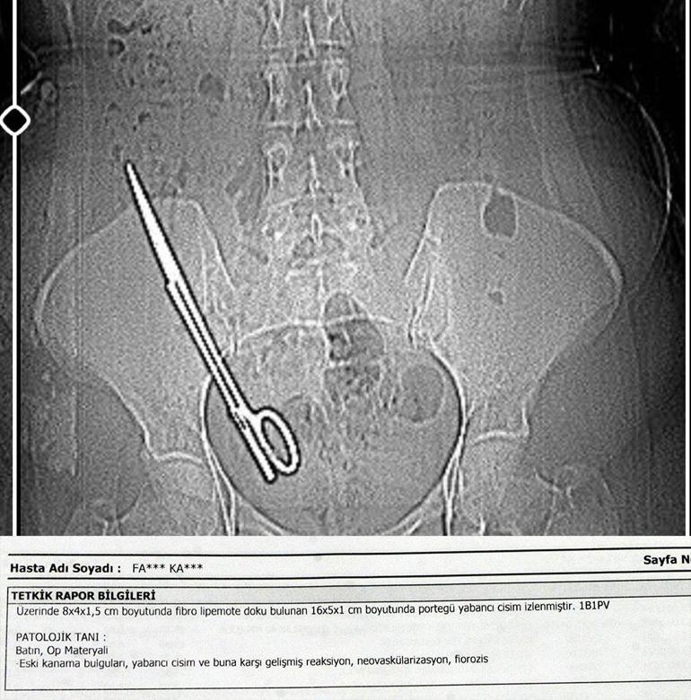 Gerçek röntgende ortaya çıktı 7 yıl karnında makasla yaşadı