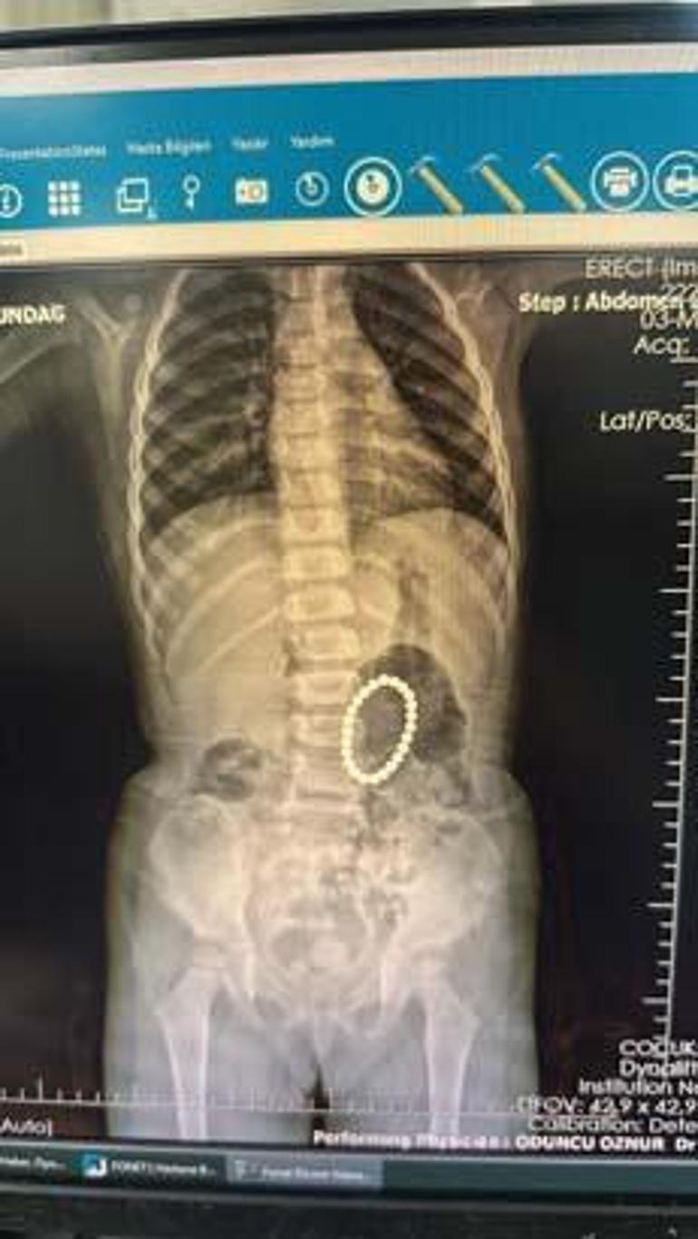 4 yaşındaki çocuğun bağırsaklarından çıkanlar şoke etti: Asla eve sokmayın