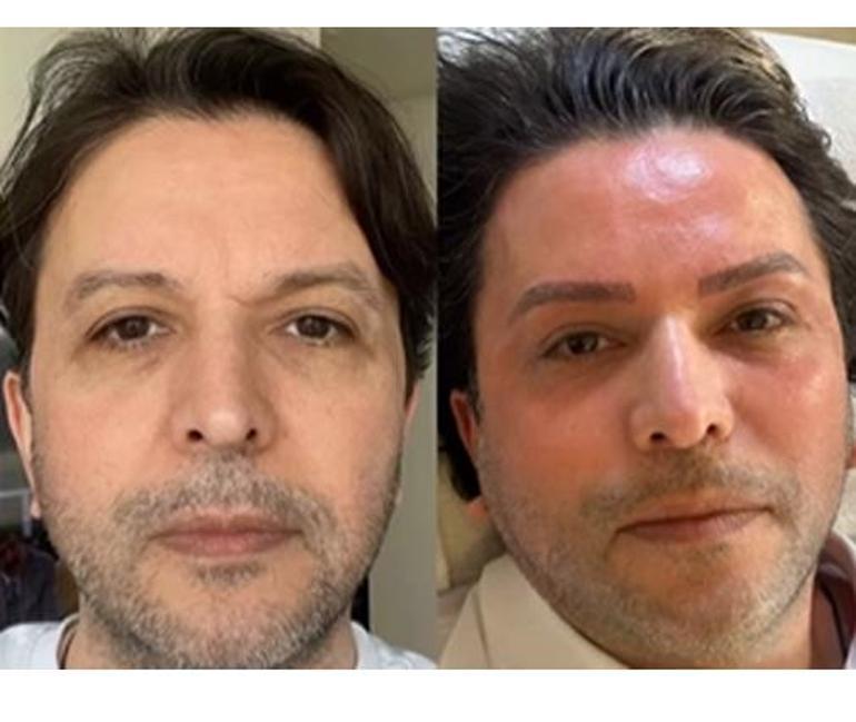 Nihat Doğanı gören tanıyamadı Estetikli yeni hali herkesi şoke etti