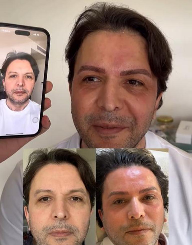 Nihat Doğanı gören tanıyamadı Estetikli yeni hali herkesi şoke etti