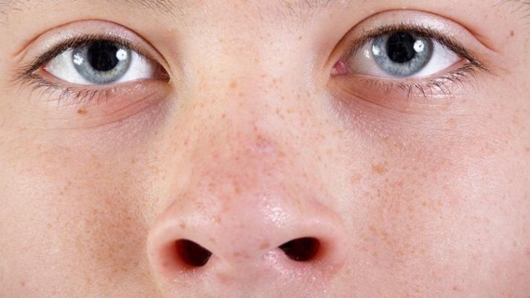 La demande de rhinoplastie a diminué jusqu'à l'âge de 15 ans, nous la recommandons après 18 ans.