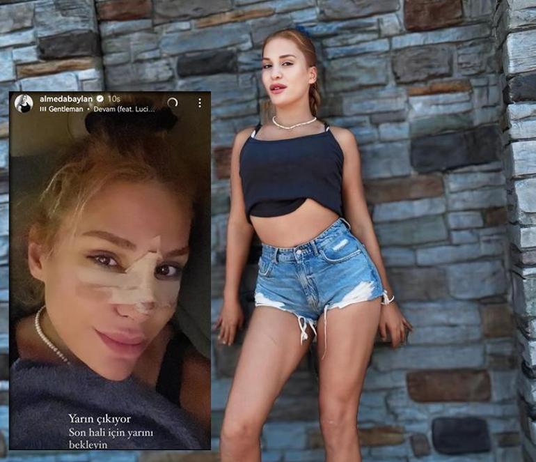 Elendikten sonra ilk iş estetik ameliyatı olmuştu Survivor Almeda Baylan son halini paylaştı