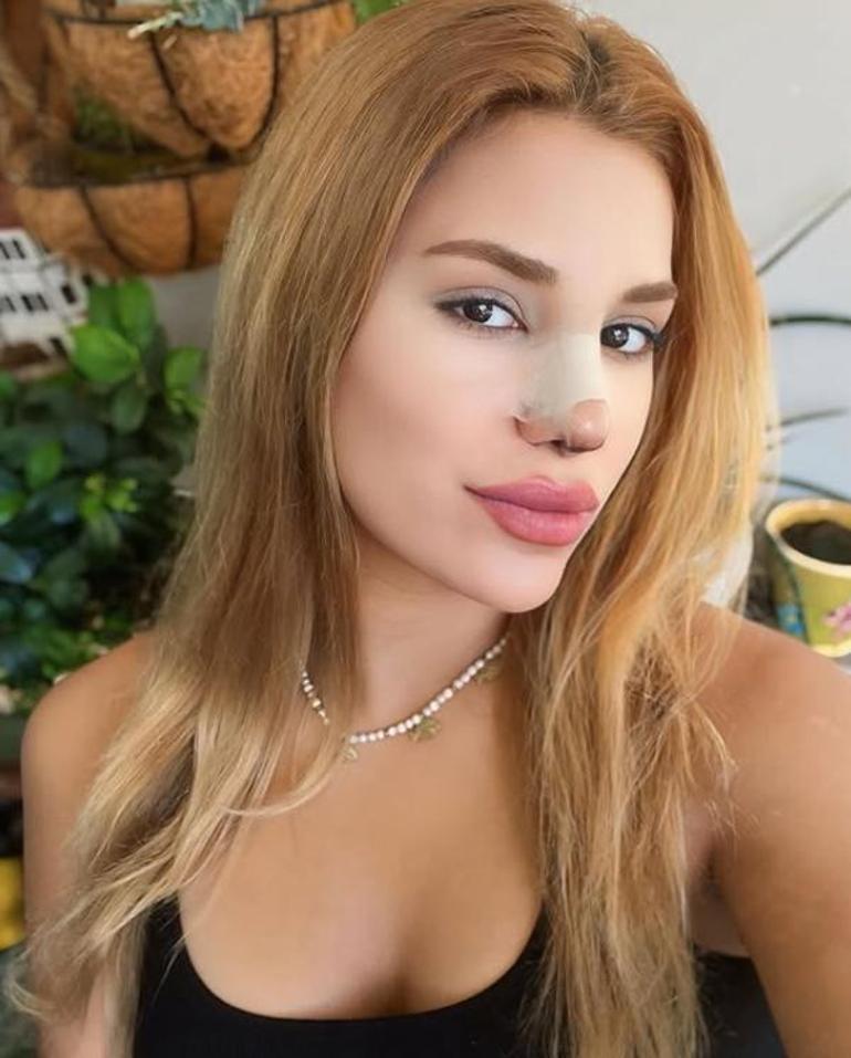 Survivor Almeda burun ameliyatı ardından son halini paylaştı Değişimi şoke etti