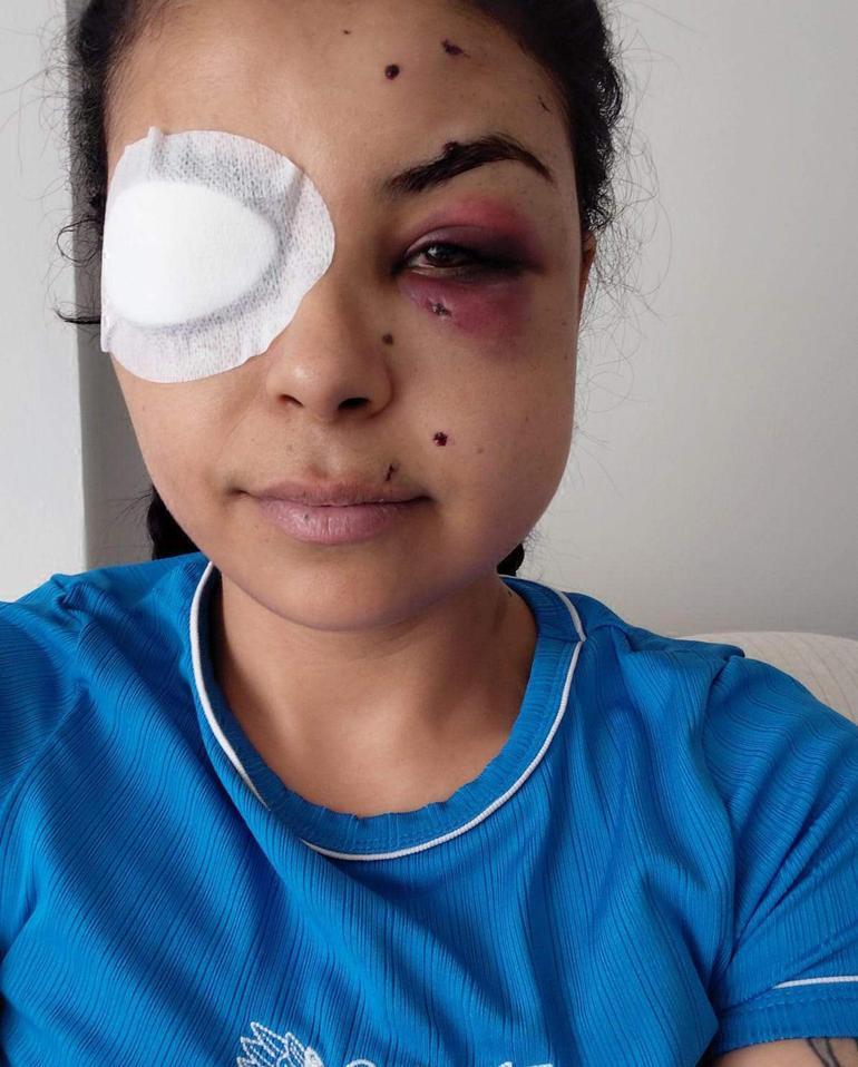Düğünde tüfekli kavga: Pencereden izlerken, gözünden vuruldu