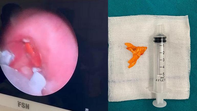 Nefes borusuna şeker ambalajı kaçtı 10 aylık bebek ölümden döndü
