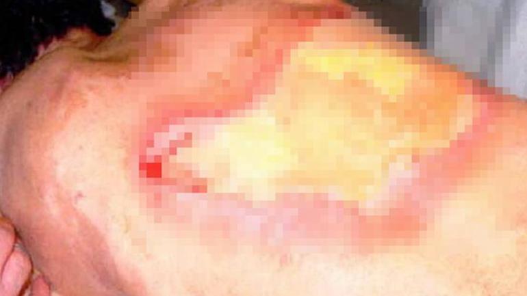 Nükleer jeneratöre çıplak elle dokundu Odun ararken radyasyondan zehirlendiler