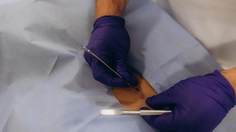 No incisions or scars. The miracle treatment that vaporizes tumors: Ablation