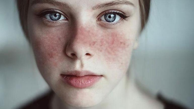 Spots on your face may be a sign of lupus. It can affect many organs.