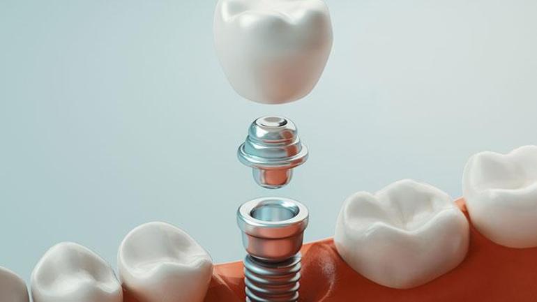 Jeder Zahnverlust erfordert ein Implantat. Durch die Zahnlosigkeit schmilzt der Kieferknochen.