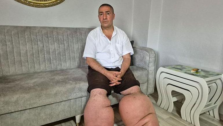 688cac6ca24008c540a89d11 15 yıldır fil hastalığıyla mücadele ediyor: 'Eşim sadece rahat bir ayakkabı giysin'
