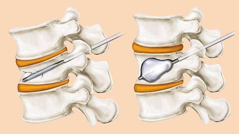 It comes into play when it breaks like in an earthquake. Bone made of cement: We were the first to do it in Türkiye.