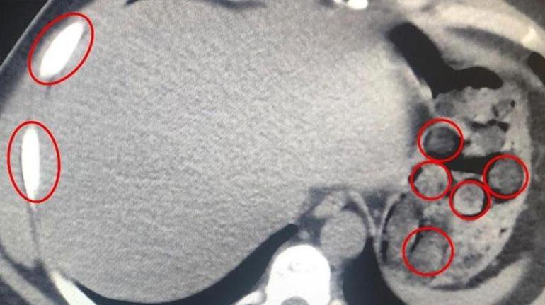 Polis kıskıvrak yakaladı Midesinden çıkanlar şaşkına çevirdi