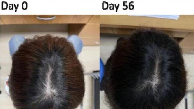 Die Haardichte stieg innerhalb von zwei Monaten um 25 Prozent: Ist dieses Serum das Heilmittel gegen Haarausfall? Hier ist die Wahrheit.