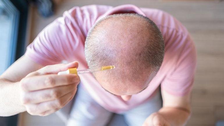 Die Haardichte stieg innerhalb von zwei Monaten um 25 Prozent: Ist dieses Serum das Heilmittel gegen Haarausfall? Hier ist die Wahrheit.