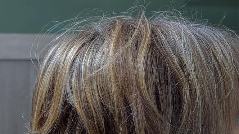 Beyaz saçların bilinmeyen sırrı Yaşlılık değilmiş: Hücreler kanserle mi savaşıyor