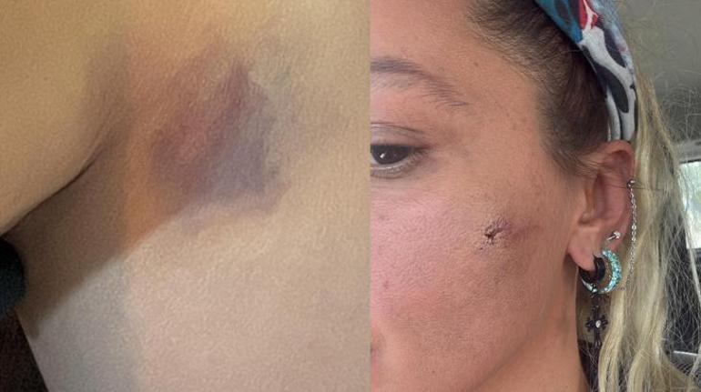 Yıldız Asyalıdan şoke eden paylaşım Kocam tarafından darp edildim