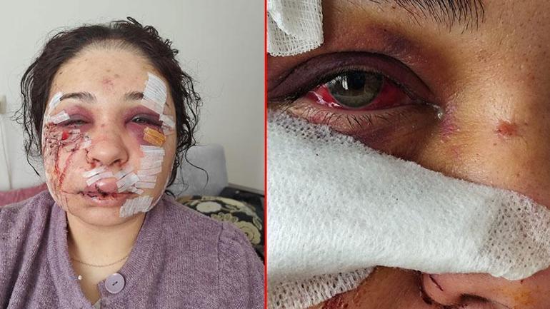 Boşanma aşamasındaki eşi ‘güzelliğini elinden alacağım’ deyip yüzünü parçaladı! EGM’den flaş açıklama - 
                    1. Resim