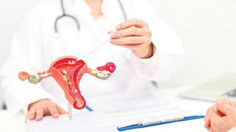 PCOS hakkında doğru bilinen yanlışlar