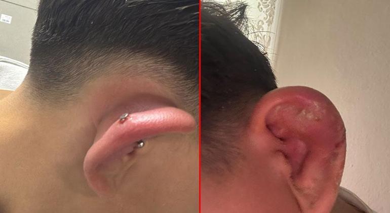 Kulağına piercing taktırdı, hayatı kabusa döndü 5 gecedir hastanede