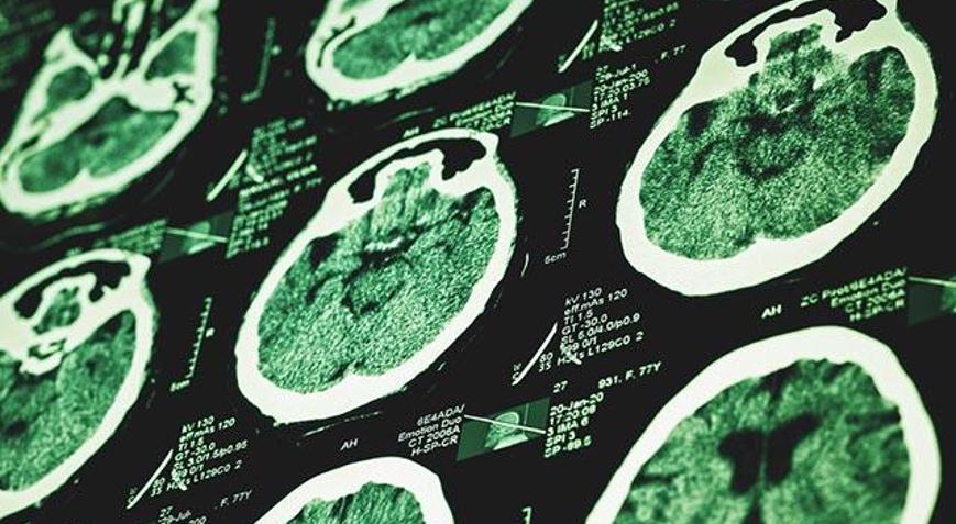 Beyin felci ile ilgili bilmeniz gerekenler