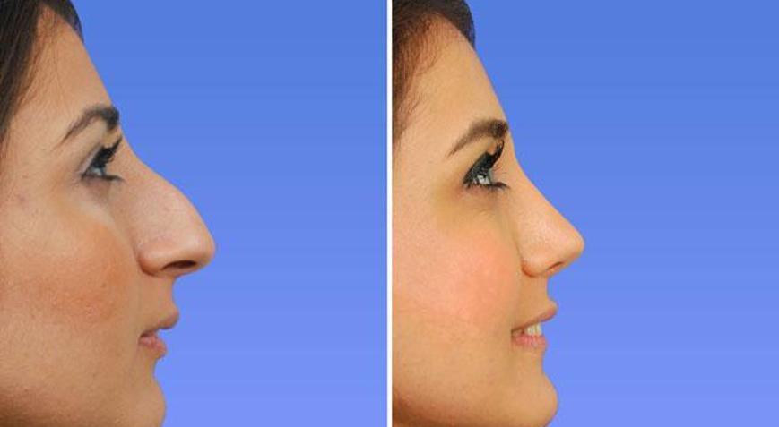 Burun estetiğinde yeni bir devir “Piezo Rinoplasti”