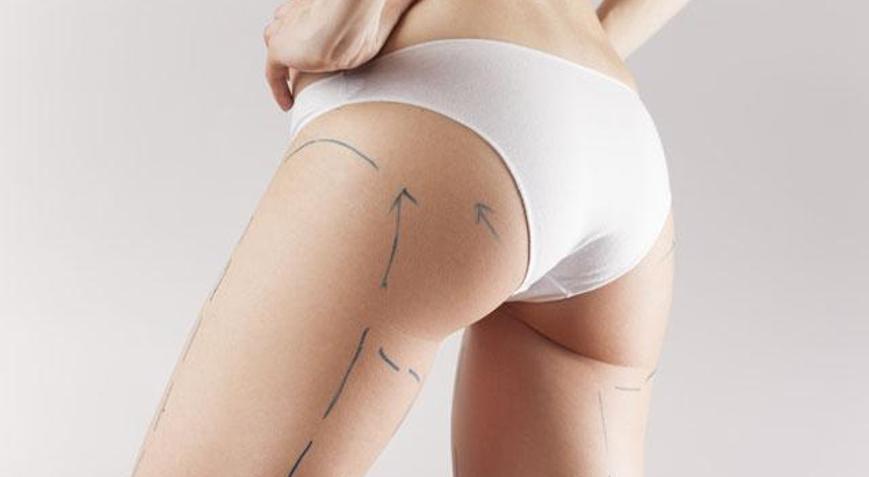Liposuction nedir, nasıl yapılır