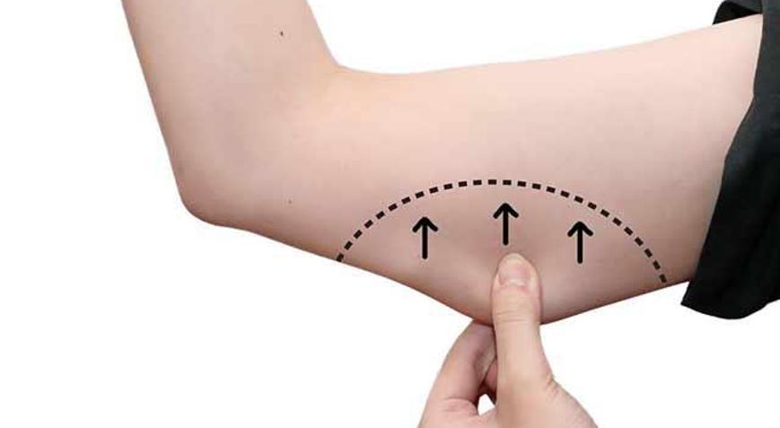 Liposuction nedir, nasıl uygulanır