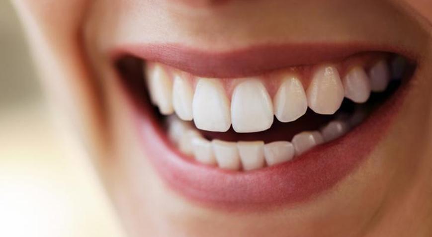 Dişe lamina uygulamaları ile ilgili merak edilenler