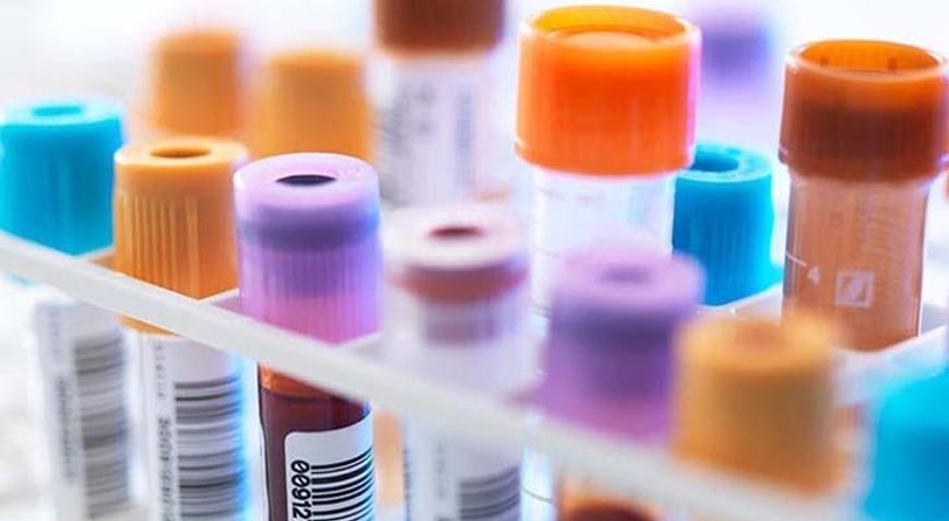 Lh Hormonu Nedir Lh Hormonu Kaç Olmalı Yüksekliği Ve Düşüklüğü Nedenleri