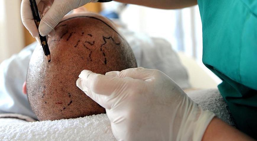 Saç ekimi ölüme götürdü