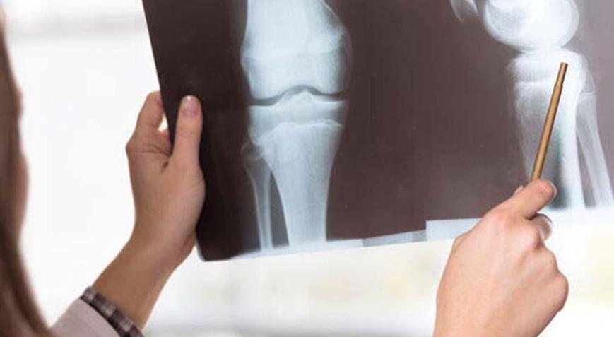 Kalça Kemiği Ağrısı Neden Olur, Nasıl Geçer? Sağ Ve Sol Kalça Kemiği ...