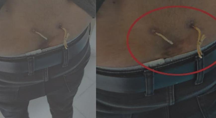 Çamaşır ipiyle tedavi skandalı Belinde iki delik açıp yaptılar