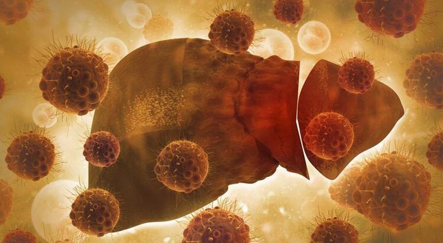 Karaciğerin sinsi hastalığına dikkat Hiçbir yakınmanız olmasa bile…