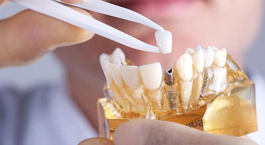 Bir günde implant tedavisi mümkün mü