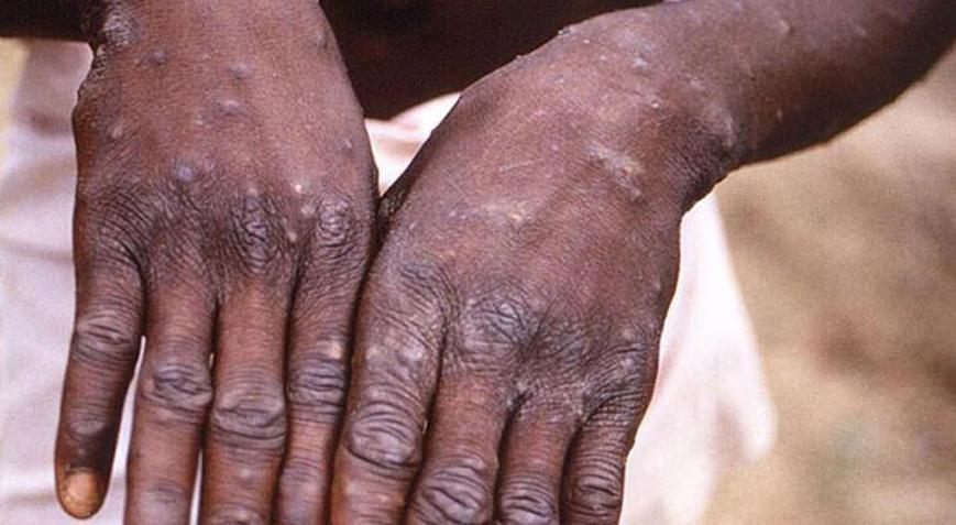 MAYMUN ÇİÇEĞİ VİRÜSÜ (MONKEYPOX) NEDİR, NASIL BULAŞIR, ÖLÜMCÜL MÜ? - Sağlık Haberleri