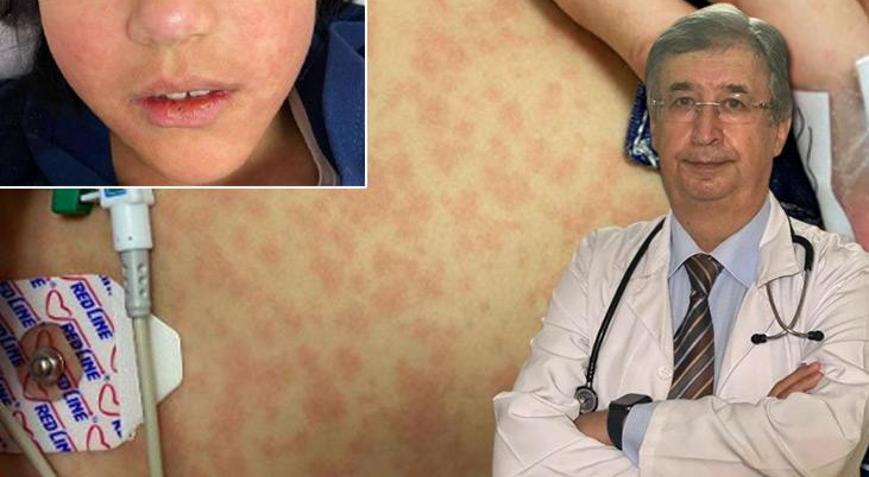 Yıllardır görülmeyen vakalar yeniden ortaya çıktı Hamile bir kadına bulaşırsa bebeği ölebilir, sakat doğabilir